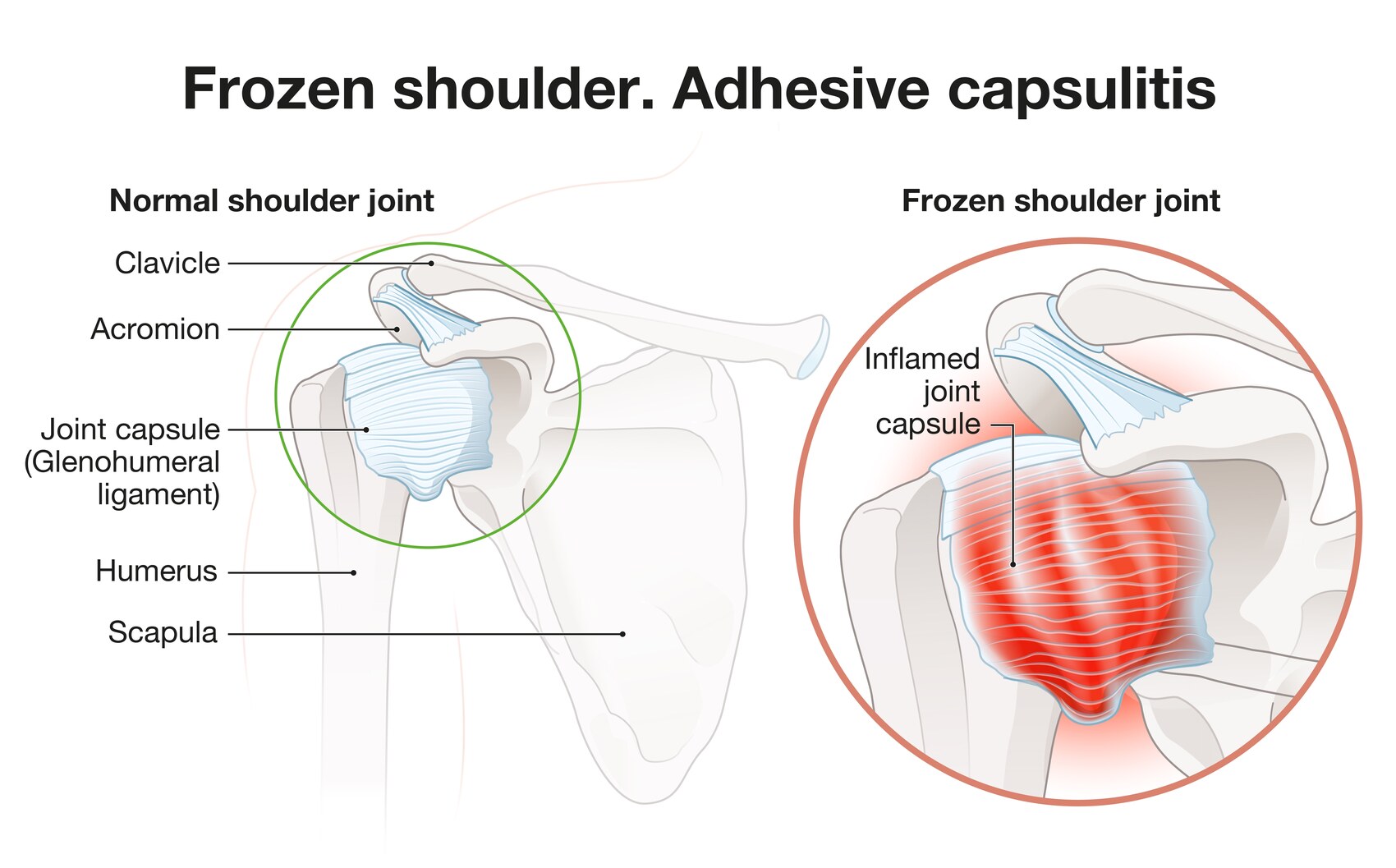illustration comparing a normal shoulder joint capsule with the inflamed thickened capsule of frozen shoulder