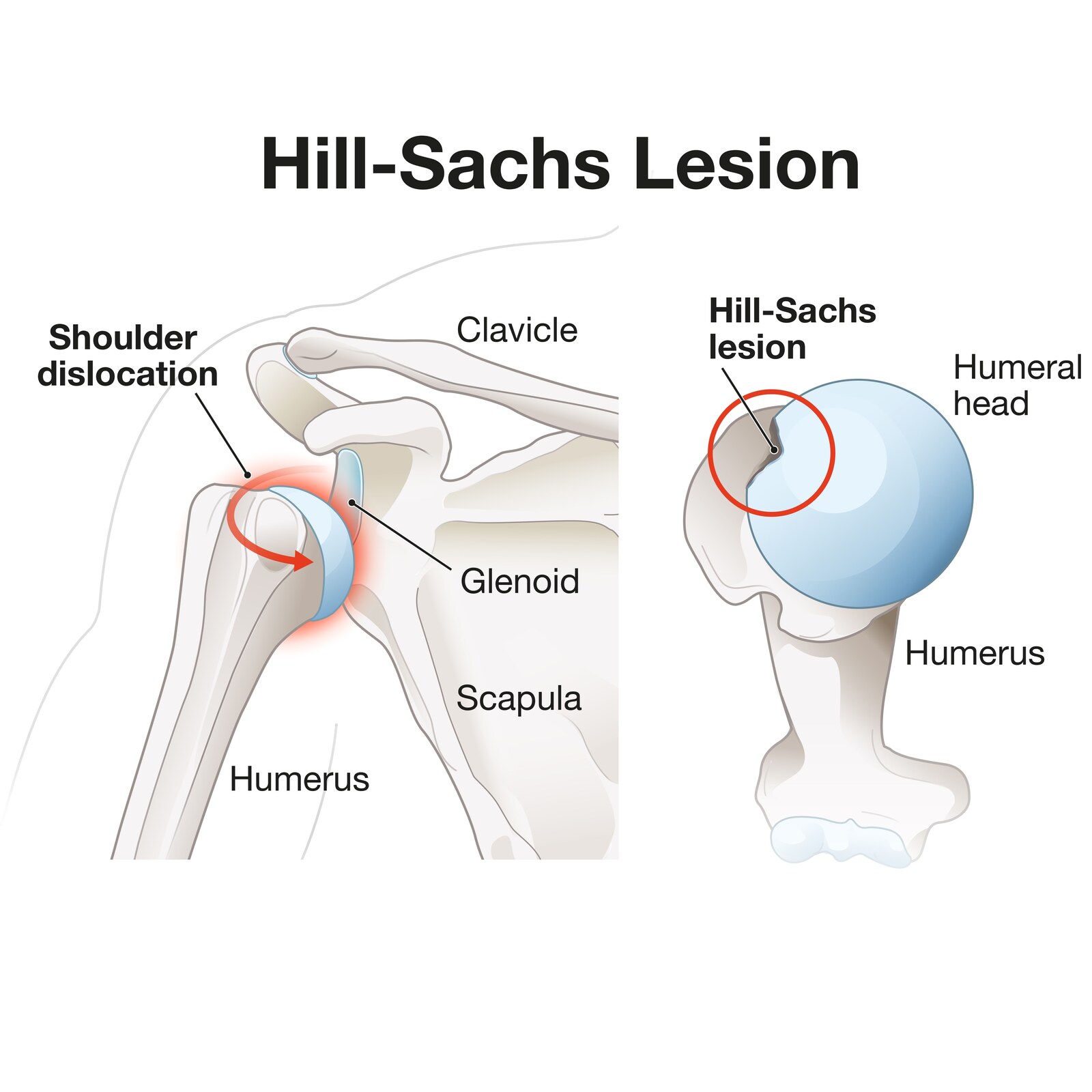 medical diagram showing a shoulder dislocation and the resulting Hill-Sachs lesion dent on the back of the humeral head