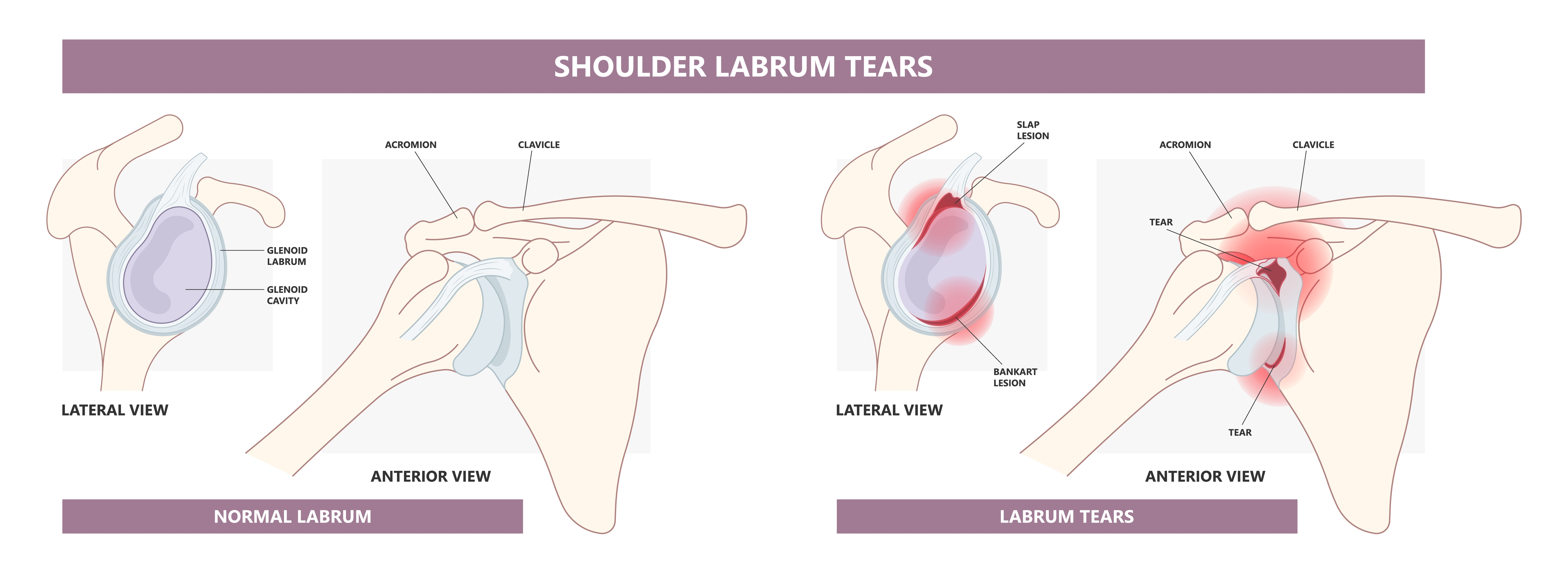 diagram comparing a normal shoulder labrum with a torn labrum showing Bankart lesion at the front rim and SLAP lesion at the top