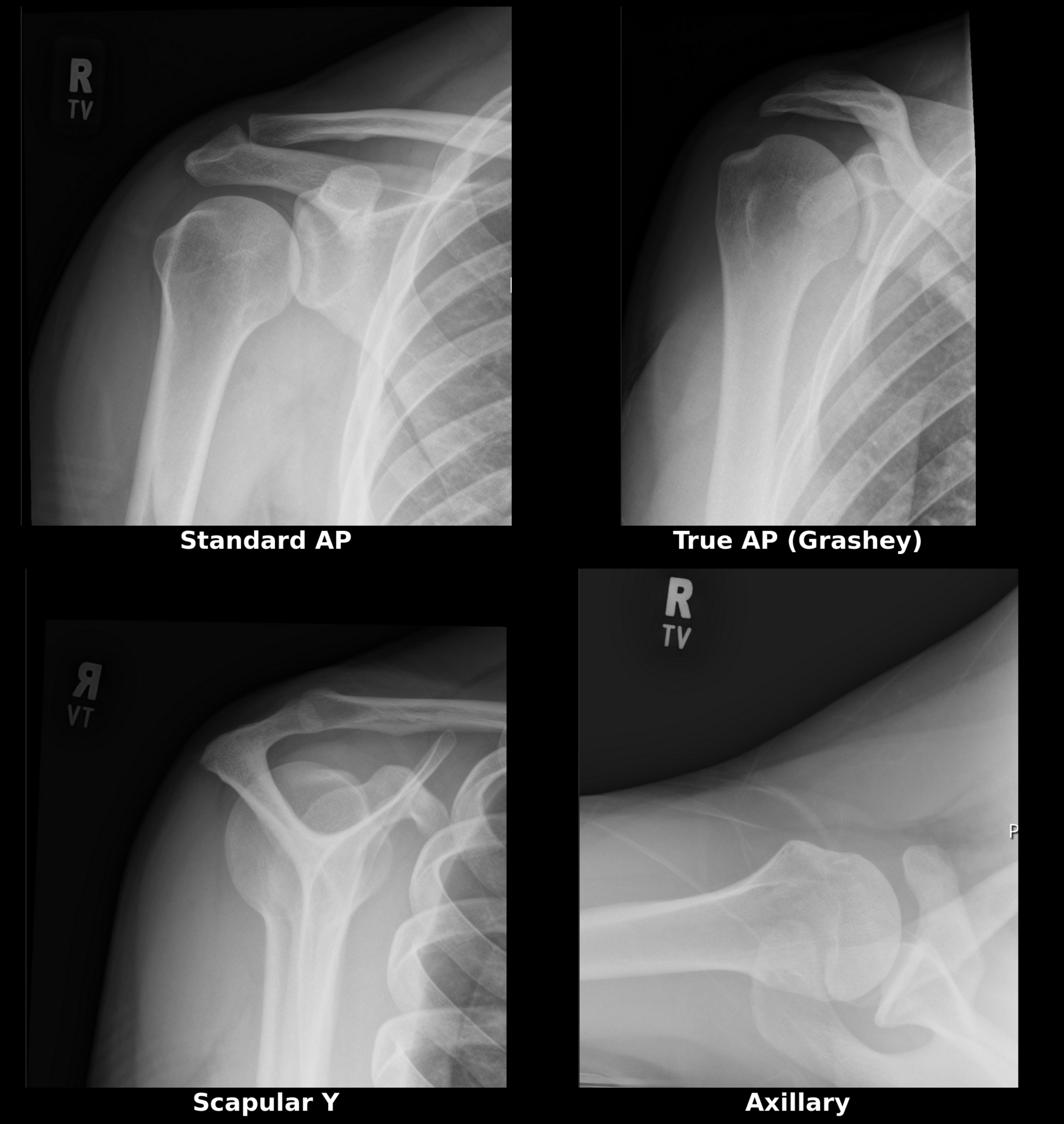 normal four view shoulder x-ray series showing standard AP, true AP Grashey, scapular Y and axillary views