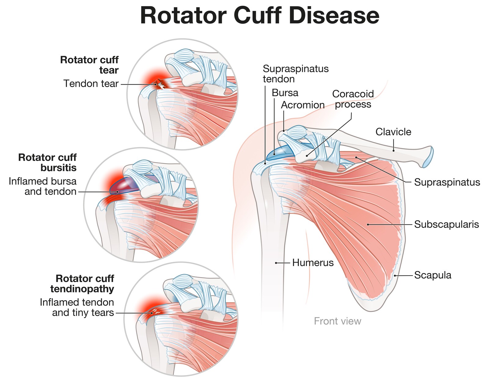 illustration comparing rotator cuff tendinopathy bursitis and a rotator cuff tear with labeled shoulder anatomy